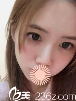 韩国枓翰整形面部填充术后30天照 韩国枓翰整形面部填充术后30天照