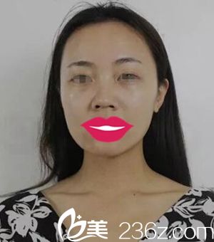 驻马店美兰德做鼻综合手术前 驻马店美兰德做鼻综合手术前