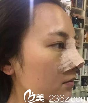 驻马店美兰德做鼻综合手术当天 驻马店美兰德做鼻综合手术当天