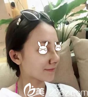 驻马店美兰德做鼻综合手术第二天 驻马店美兰德做鼻综合手术第二天