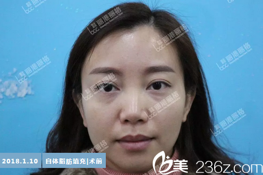 在深圳丽港丽格整形医院做脂肪填充前