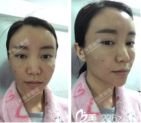 自体脂肪面部填充术后3天