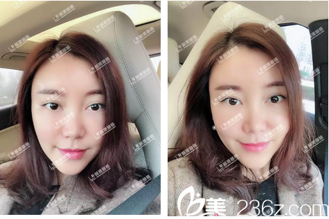 自体脂肪面部填充术后两周图片