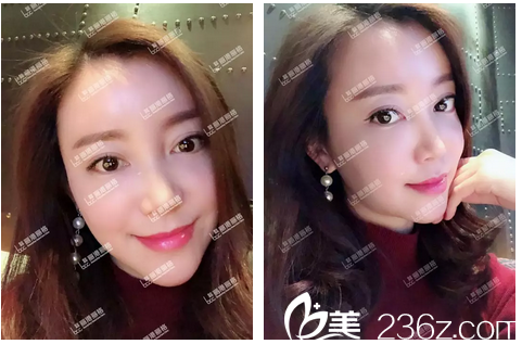 自体脂肪填充全脸术后一个月