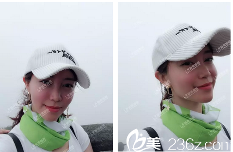 做完自体脂肪填充全脸术后两个月