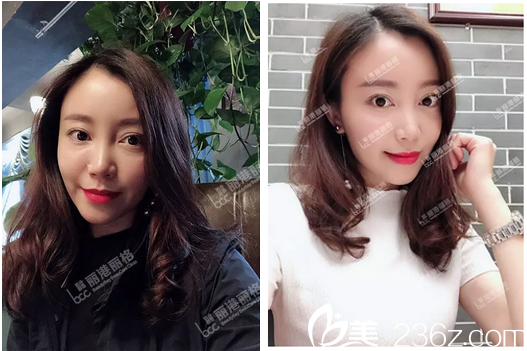 深圳丽港丽格谢俊做的自体脂肪面部填充全脸案例图