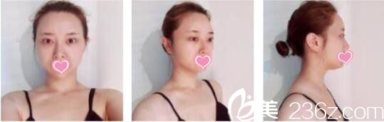 韩国DrBe整形外科<!--<i data=20240703-sp></i>-->金泰中面部埋线提升真人案例术前照 韩国DrBe整形外科<!--<i data=20240703-sp></i>-->金泰中面部埋线提升真人案例术前照