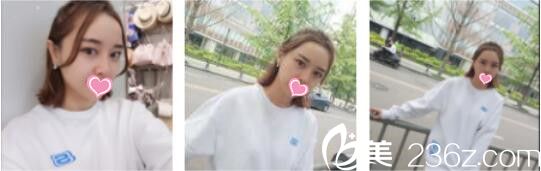 韩国DrBe整形外科<!--<i data=20240703-sp></i>-->金泰中面部埋线提升真人案例术后第十天 韩国DrBe整形外科<!--<i data=20240703-sp></i>-->金泰中面部埋线提升真人案例术后第十天