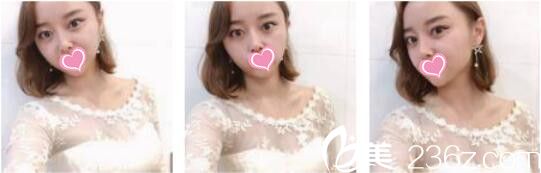 韩国DrBe整形外科<!--<i data=20240703-sp></i>-->金泰中面部埋线提升真人案例术后十五天 韩国DrBe整形外科<!--<i data=20240703-sp></i>-->金泰中面部埋线提升真人案例术后十五天