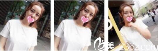 韩国DrBe整形外科<!--<i data=20240703-sp></i>-->金泰中面部埋线提升真人案例术后一个月 韩国DrBe整形外科<!--<i data=20240703-sp></i>-->金泰中面部埋线提升真人案例术后一个月