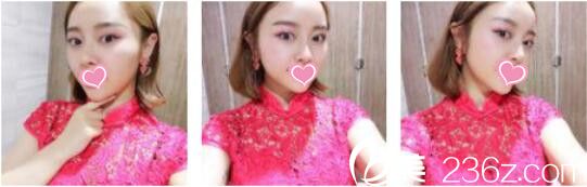 韩国DrBe整形外科<!--<i data=20240703-sp></i>-->金泰中面部埋线提升真人案例术后两个月 韩国DrBe整形外科<!--<i data=20240703-sp></i>-->金泰中面部埋线提升真人案例术后两个月