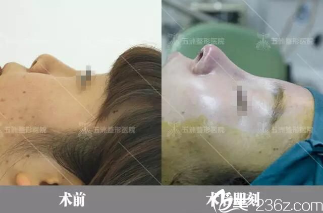 术后即刻对比效果 术后即刻对比效果