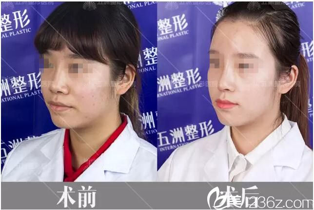 术后15天侧面对比效果 术后15天侧面对比效果