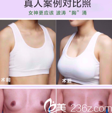 刘明飞医生假体丰胸真人效果图分享