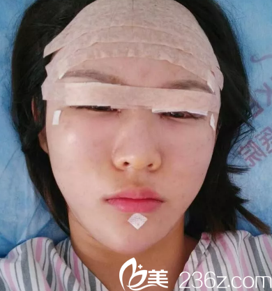 济南美莲整形美容医院全切双眼手术当天的照片 济南美莲整形美容医院全切双眼手术当天的照片