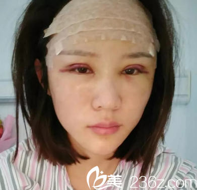 我还做了自体脂肪填充额头 我还做了自体脂肪填充额头