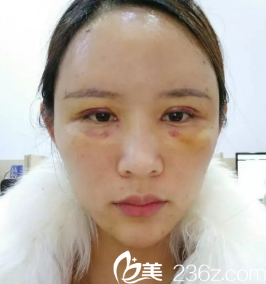 眼睛真的好肿哦 眼睛真的好肿哦