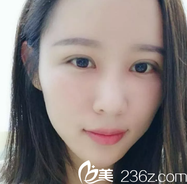 大家看我的眼睛恢复的怎么样啊 大家看我的眼睛恢复的怎么样啊