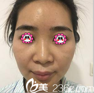 在北京亚韩做脂肪填充前样子 在北京亚韩做脂肪填充前样子