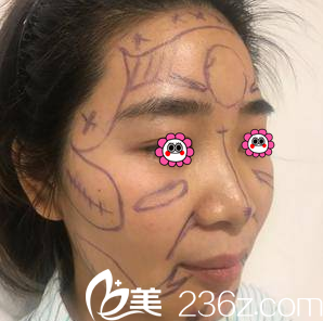 亚韩医生给我进行V塑加面部脂肪填充设计照 亚韩医生给我进行V塑加面部脂肪填充设计照