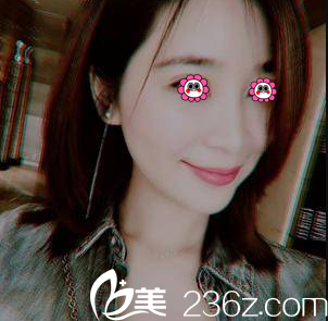 在北京亚韩做V塑加面部脂肪填充第35天效果 在北京亚韩做V塑加面部脂肪填充第35天效果