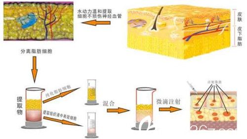 自体脂肪填充全脸