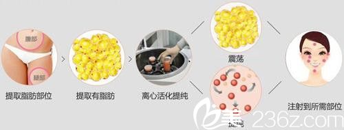 比起玻尿酸，自体脂肪有哪些优势？