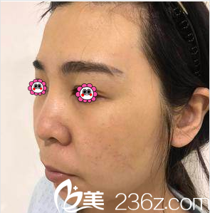 在北京亚韩做面部吸脂前样子 在北京亚韩做面部吸脂前样子