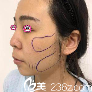 医生给我做V塑减面部吸脂设计照 医生给我做V塑减面部吸脂设计照