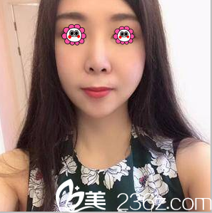 在北京亚韩做V塑减面部吸脂第26天效果 在北京亚韩做V塑减面部吸脂第26天效果