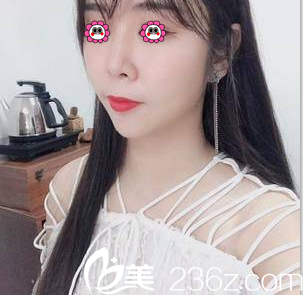 我在北京亚韩做V塑减面部吸脂第48天效果 我在北京亚韩做V塑减面部吸脂第48天效果