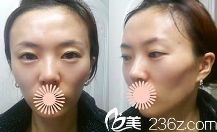 韩国丽珍整形医院手术当天拍的照 韩国丽珍整形医院手术当天拍的照