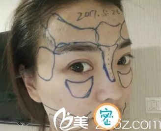 看医生给我画的线哦