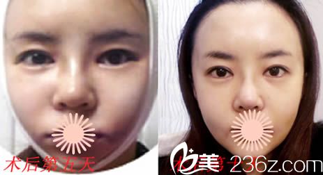 韩国丽珍面部轮廓整形和自体脂肪面部填充术后第5天和第10天照