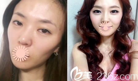 韩国丽珍整形面部轮廓和自体脂肪面部填充术对比照