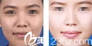 刘海涛医生注射玻尿酸填充鼻唇沟案例