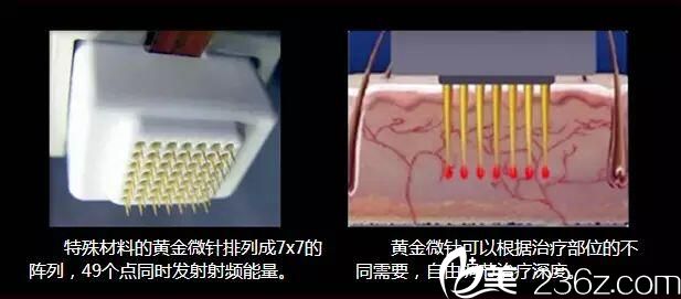 黄金点阵射频多久可以外出