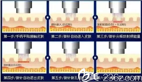 黄金点阵射频和热玛吉的区别