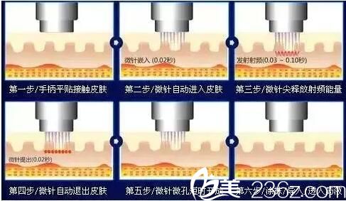 黄金点阵射频和热玛吉的区别