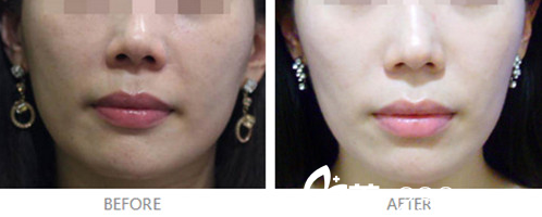 埋线提升对比图 埋线提升对比图