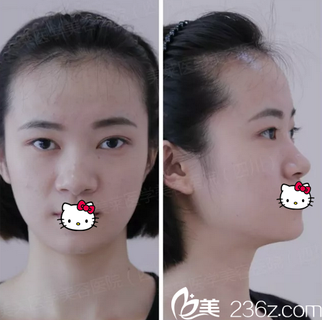 自体肋软骨隆鼻术前照片 自体肋软骨隆鼻术前照片