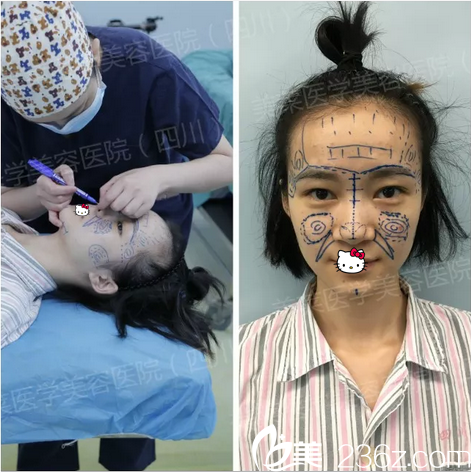 肋软骨隆鼻+脂肪面部填充术前设计 肋软骨隆鼻+脂肪面部填充术前设计