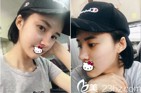 黄小林鼻综合拆线后效果 黄小林鼻综合拆线后效果