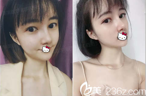  ​成都美莱黄小林跟雷状我选黄小林做肋软骨隆鼻手术的原因 