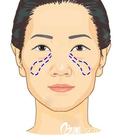 脸上苹果肌下垂怎么办