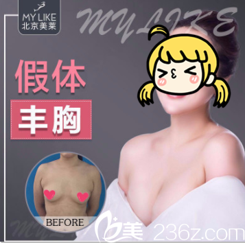 北京美莱假体隆胸案例