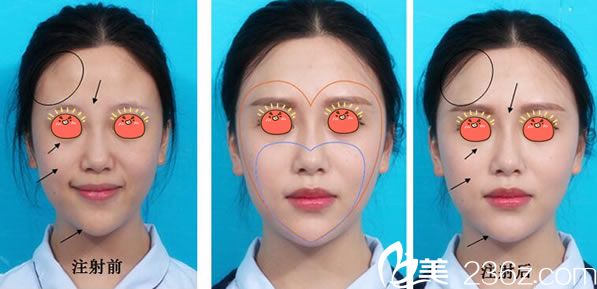 温州芘丽芙玻尿酸丰苹果肌案例