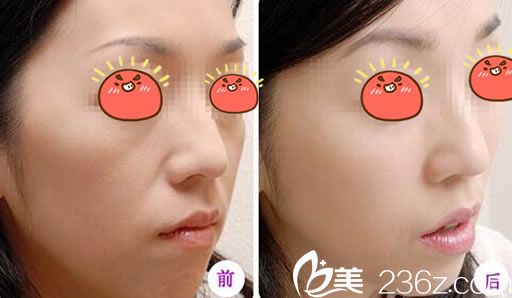 温州芘丽芙自体脂肪填充苹果肌案例