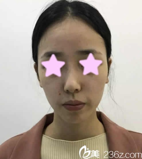 我在长治悦美整形美容医院做鼻综合前的照片 我在长治悦美整形美容医院做鼻综合前的照片