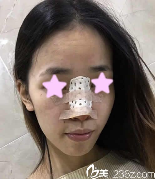 我在长治悦美整形做鼻综合隆鼻后第3天的照片 我在长治悦美整形做鼻综合隆鼻后第3天的照片